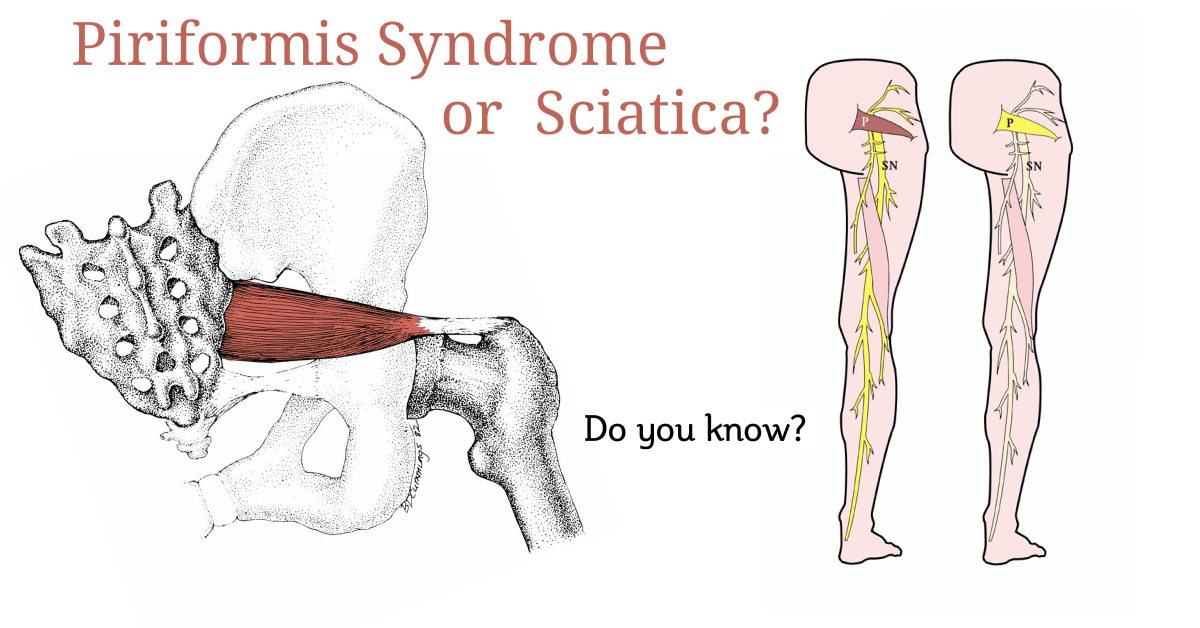 Sciatica And Piriformis Syndrome Treatment While Driving