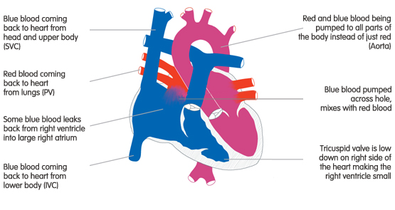 Corience Ebstein`s Anomaly