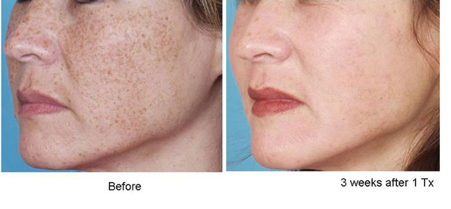What Is PhotoFacial And When Should You Have One? Corinna B's World