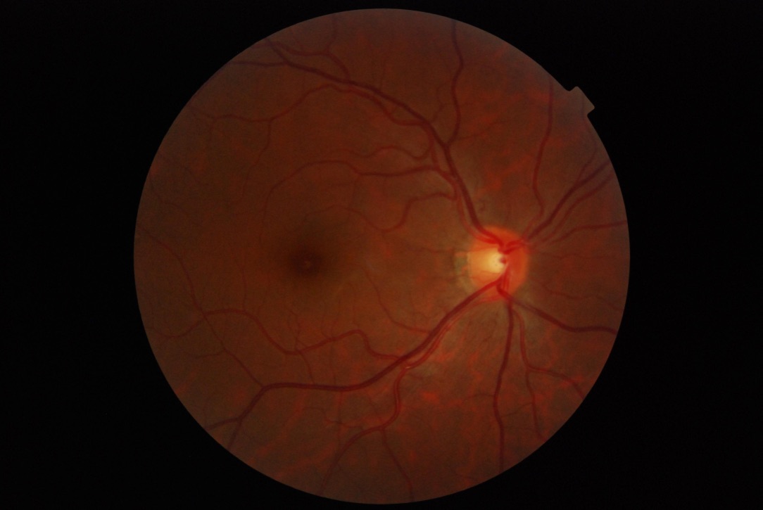 Optometry Retinal Imaging in Markham, ON Cornell Optometry