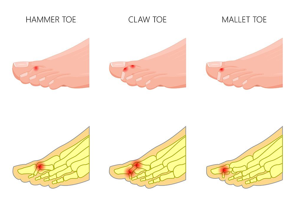 Hammertoe Corona Foot and Ankle Wound Care Center
