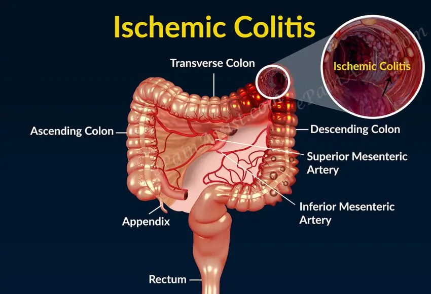 How serious is ischemic colitis? Corpus Magazine