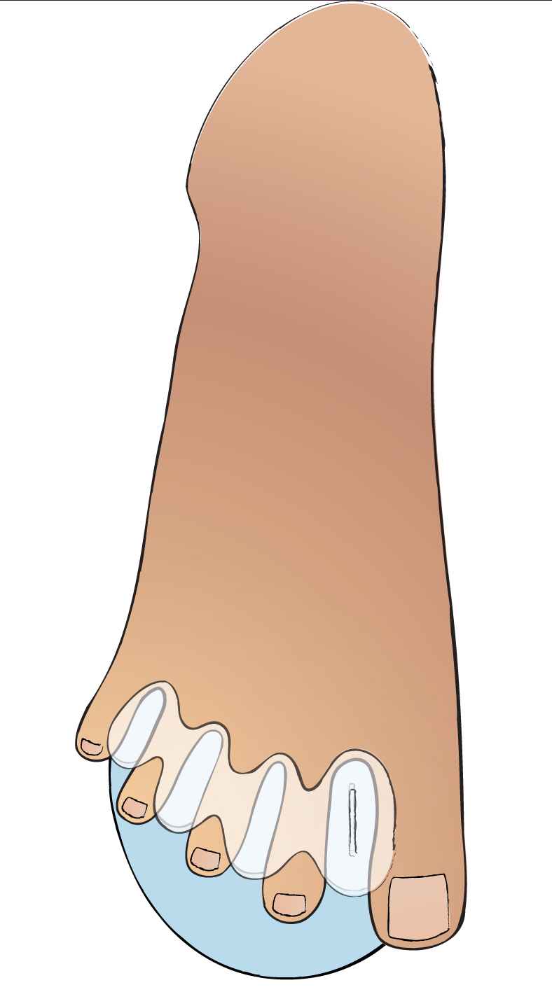 What Does OverPronation Of The Feet Mean debbiehigashida