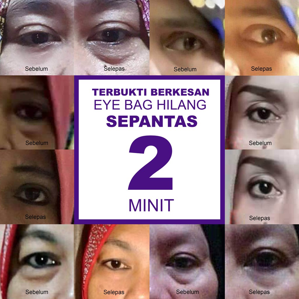 Macam Mana Nak Hilangkan Eyebag Dlm 5 Minit Dengan 3 Cara Sahaja.