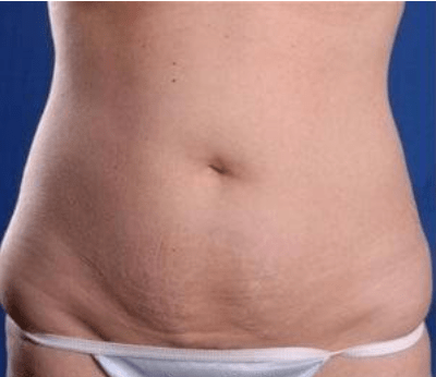 Liposuctie: Lees Hier Alles Wat Je Moet Weten - Cosmediate