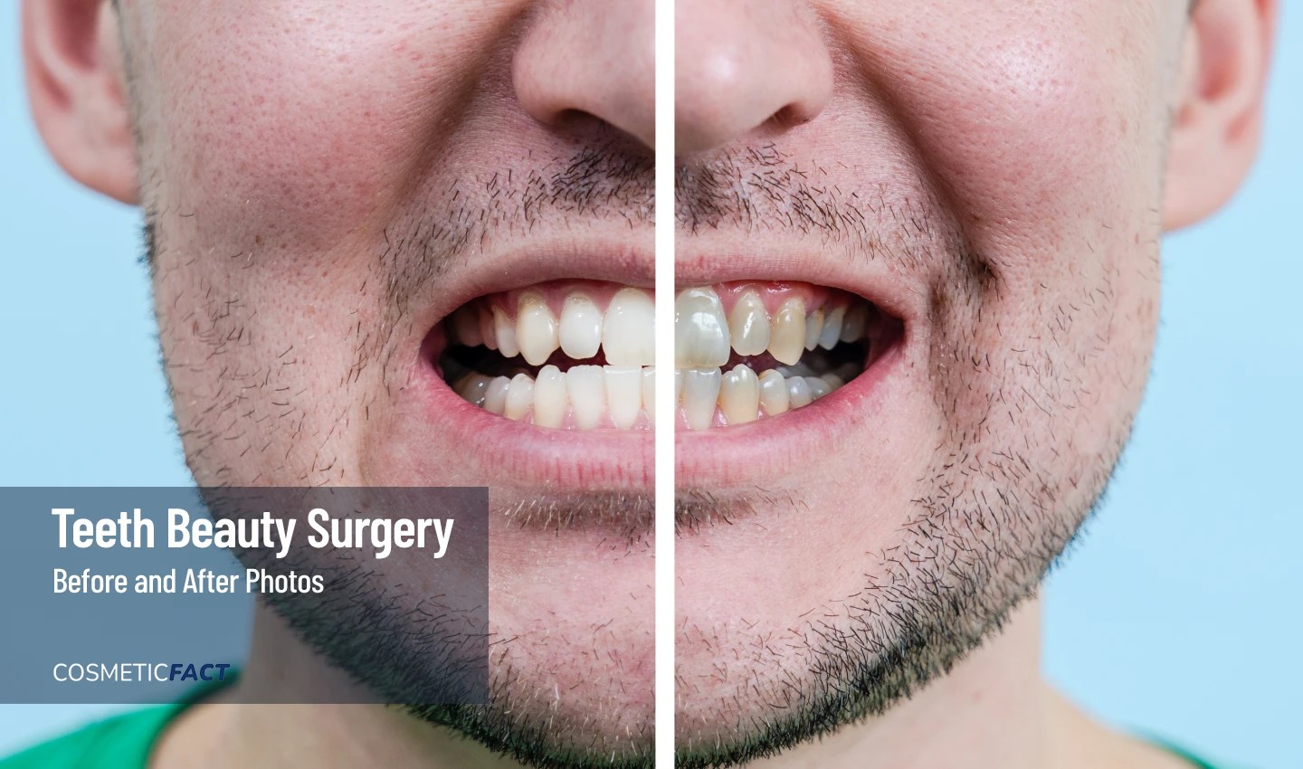 Before and After Photos of Cosmetic Dentistry See the Amazing Results