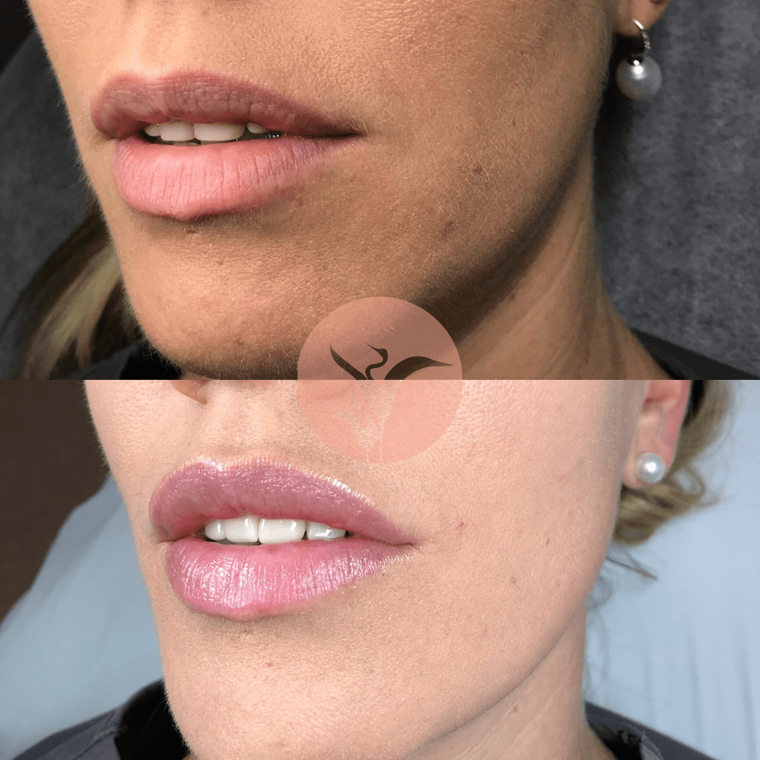 Dermal Fillers? The Side Effects Explained Cosmetic Injectables Australia