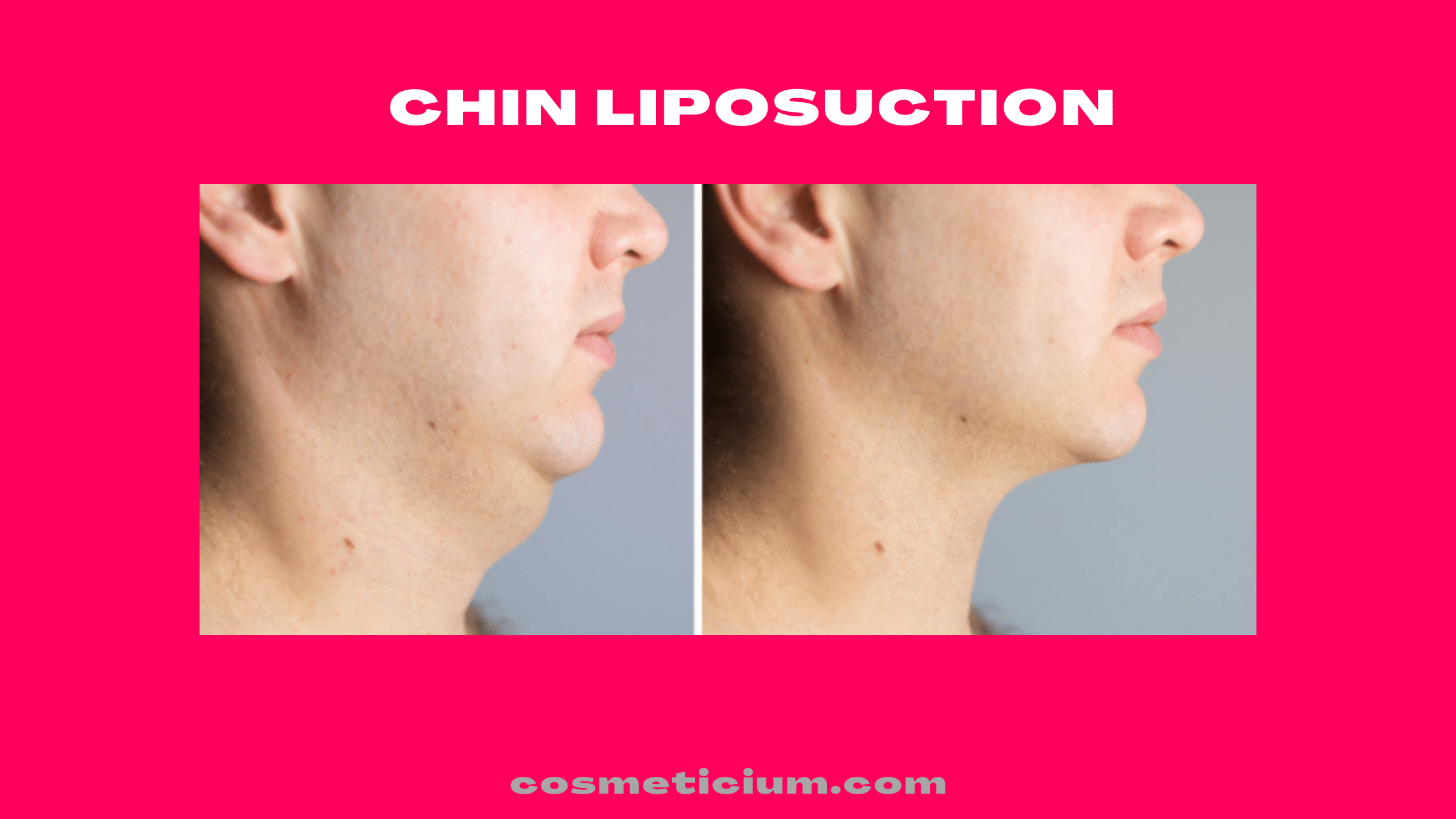 Chin Liposuction Complete Guide Cosmeticium