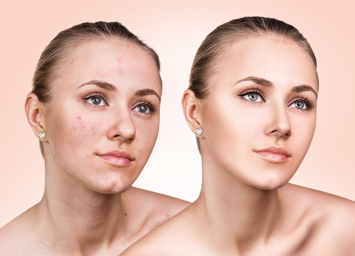 How to get rid of adult acne? Cosmetic Skin Care Blog