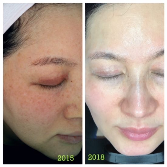 Asian Cosmetic Treatments Lasers, Skin Whitening, Nose Injections