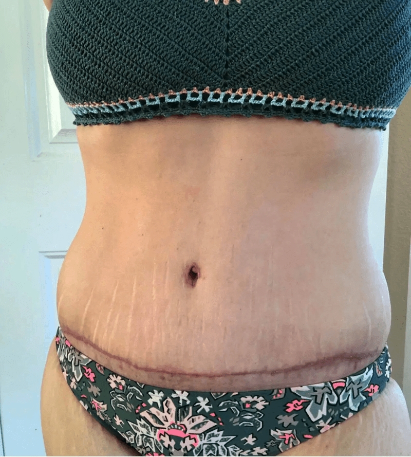 Swelling after tummy tuck 4 weeks Cosmetic Surgery Tips