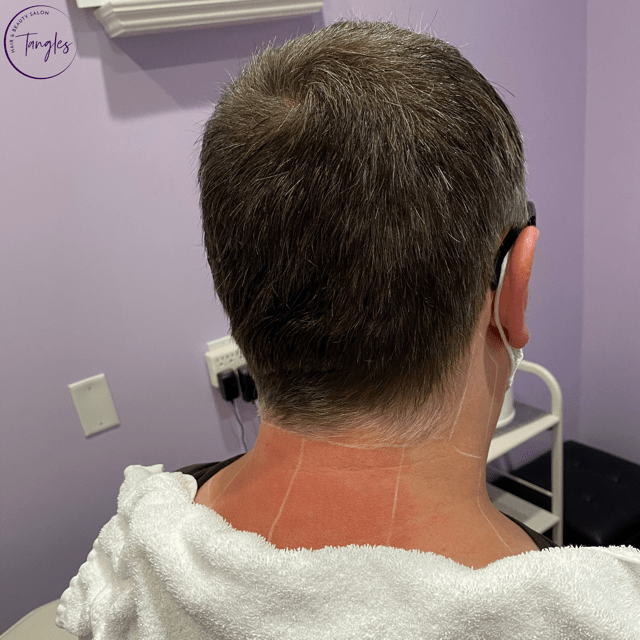 How Much Laser Hair Removal For Neck Cosmetic Surgery Tips