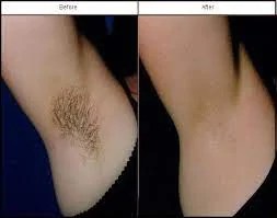 How much does laser hair removal cost for underarms Cosmetic Surgery Tips