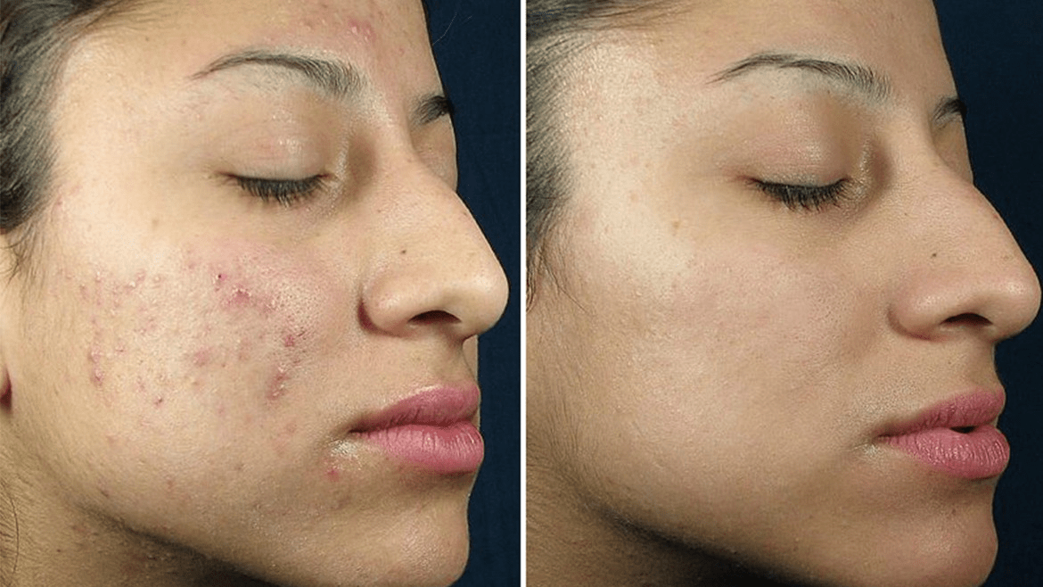 Skin Looks Worse After Chemical Peel Cosmetic Surgery Tips