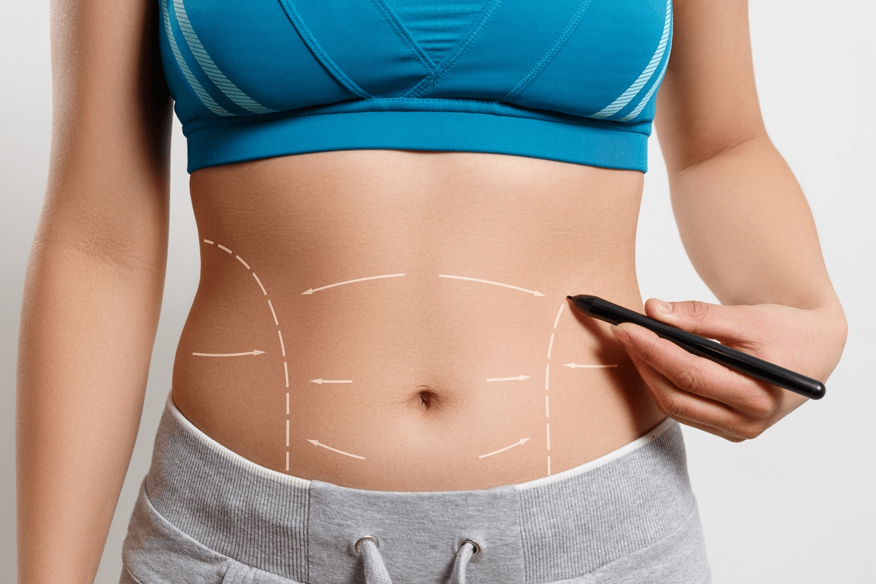 Tummy tuck cost in chicago Cosmetic Surgery Tips