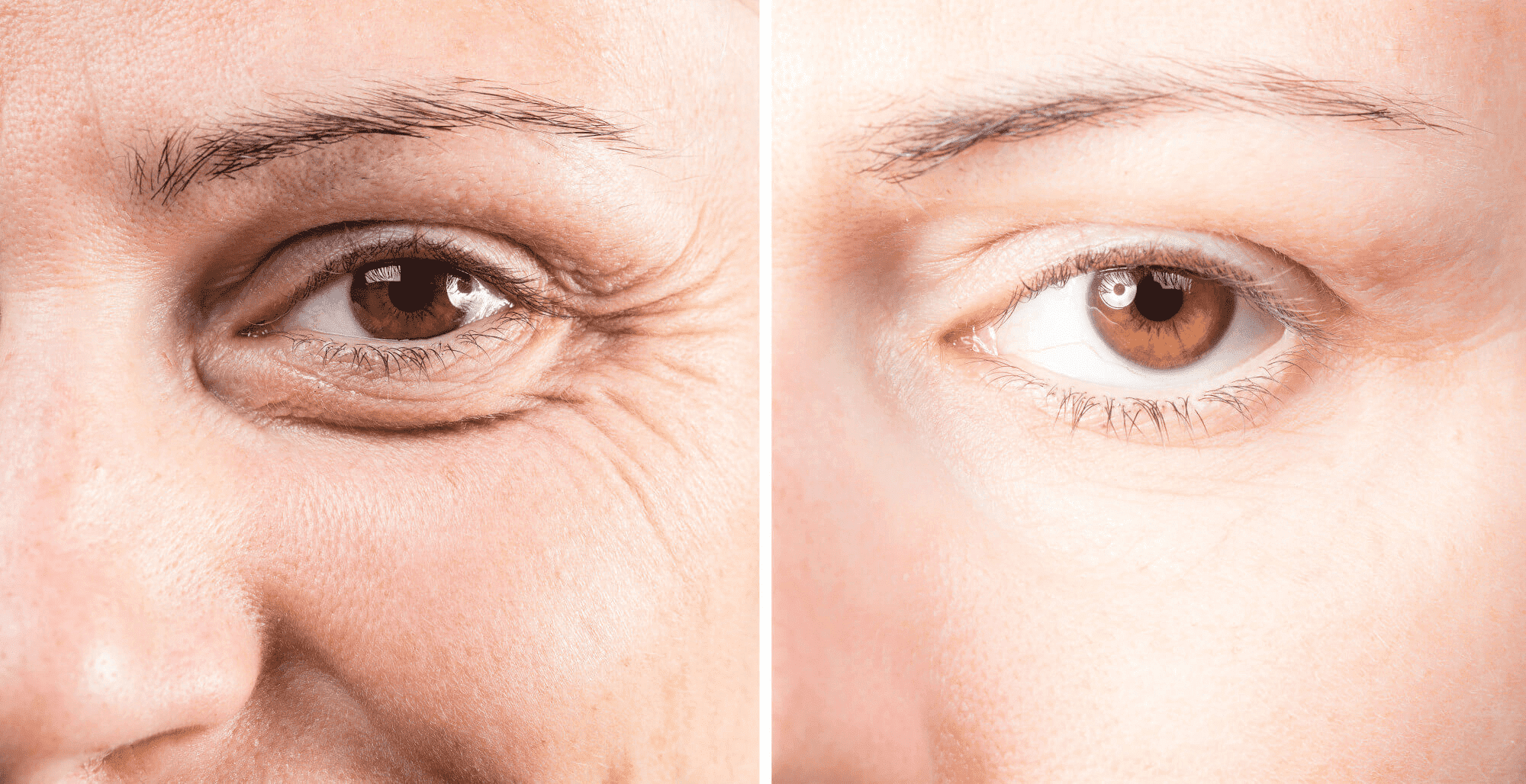 How Painful is Eyelid Lift Surgery Cosmetic Surgery Tips