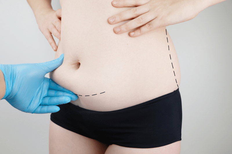 Cost Of Tummy Tuck In Las Vegas Cosmetic Surgery Tips