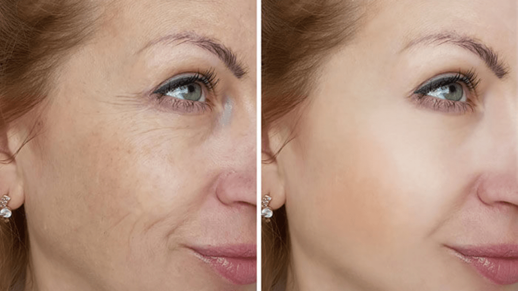 Dermaplaning Before Microneedling Cosmetic Surgery Tips