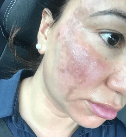 Face laser hair removal burns Cosmetic Surgery Tips