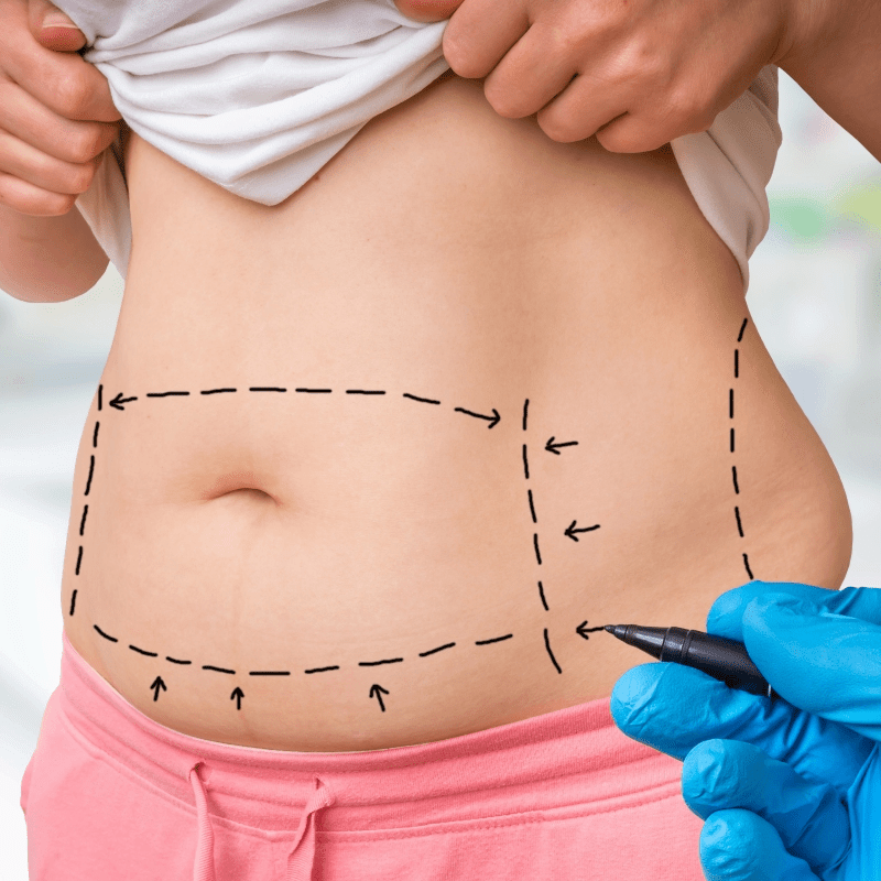 Average cost of tummy tuck in iowa Cosmetic Surgery Tips