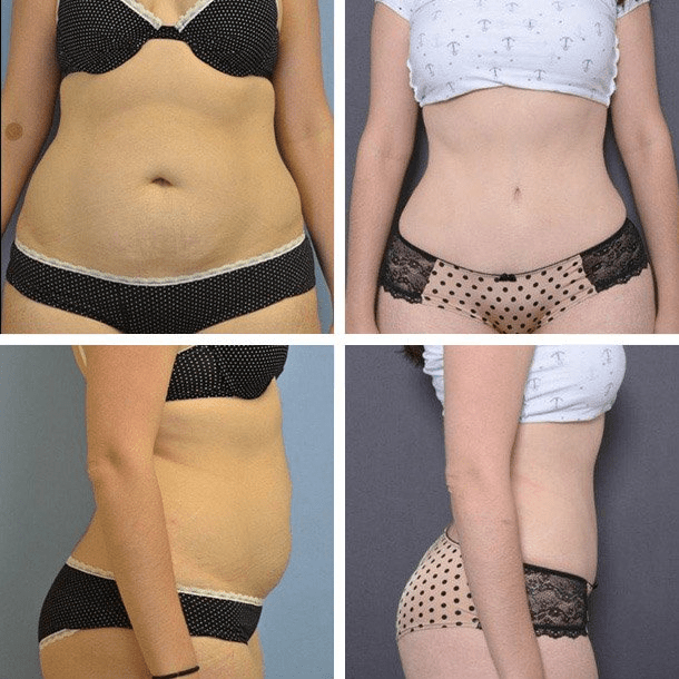 Best Tummy Tuck Surgeon In Houston CosmeticsEnvogue