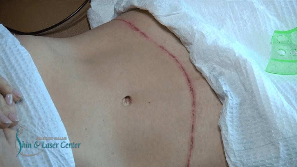 Tattoos to cover a tummy tuck scar Cosmetic Surgery Tips