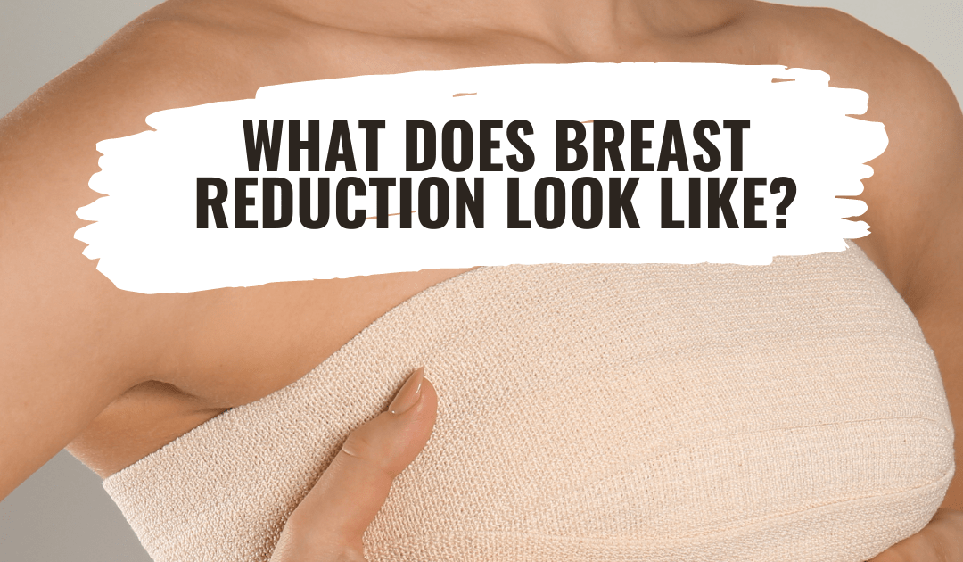 How Long Is the Hospital Stay After Breast Reduction Surgery Cosmetic