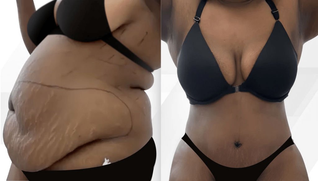 Average Cost of A Tummy Tuck in Florida Cosmetic Surgery Tips