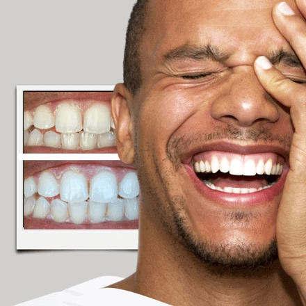 How To Use Smile Direct Club Teeth Whitening