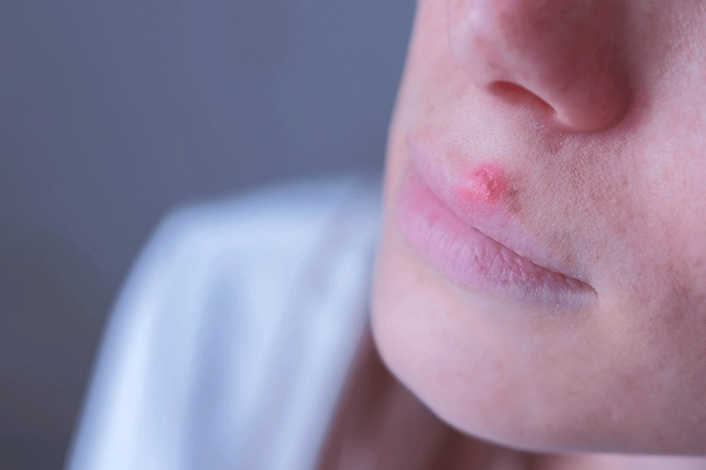 Herpes Laser Hair Removal