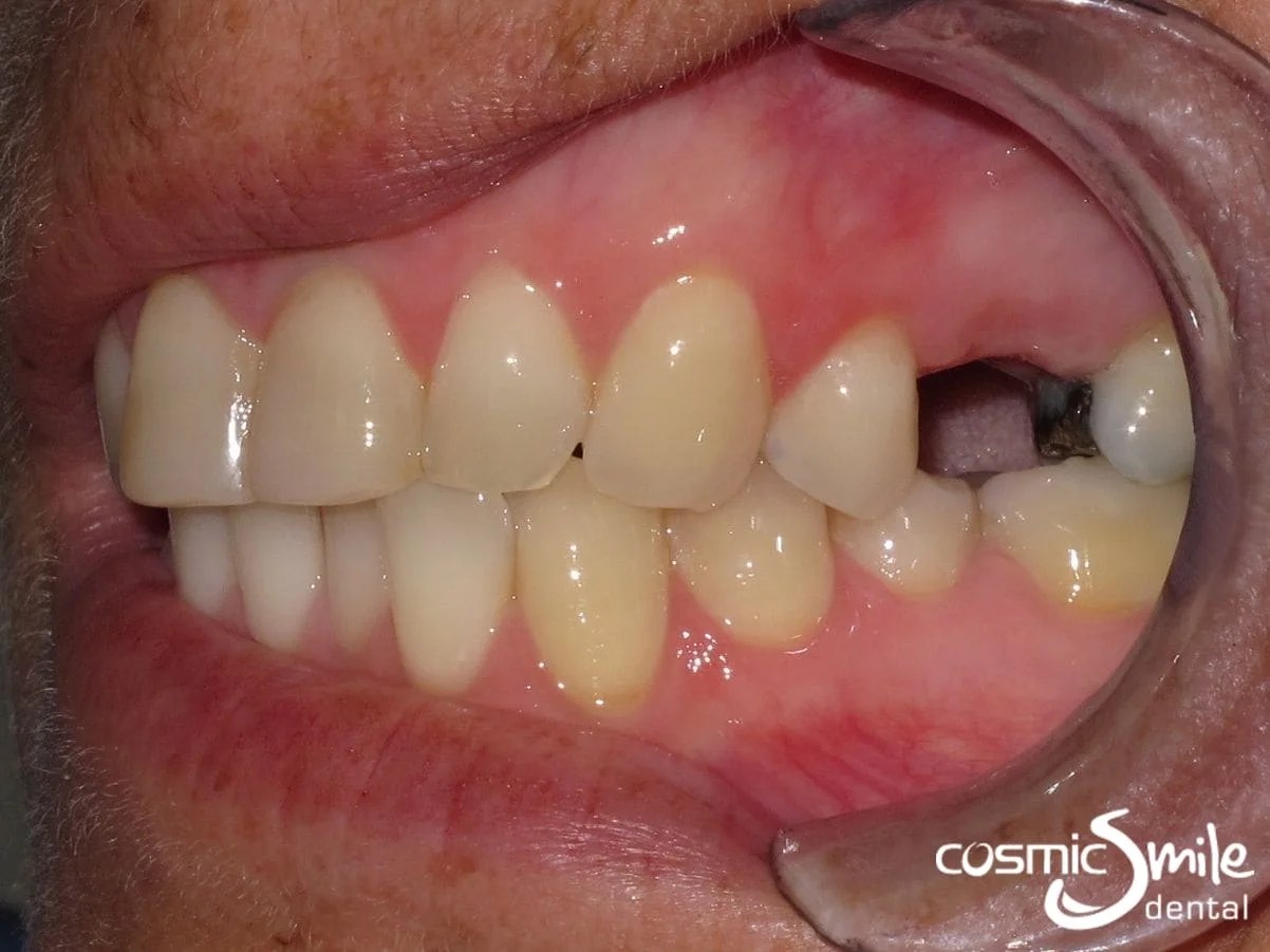 Snap on Smile Before and After Cosmic Smile Dental