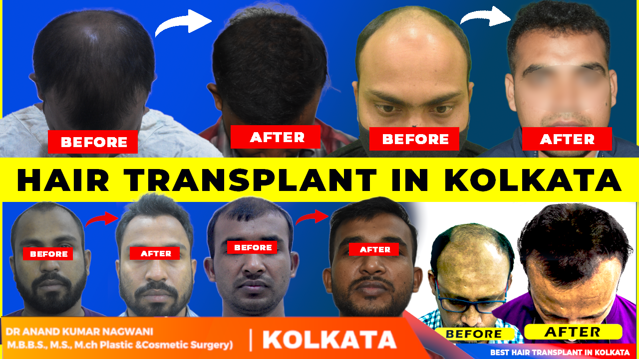 Top benefits of hair transplant in kolkata by 1 Dr. Nagwani