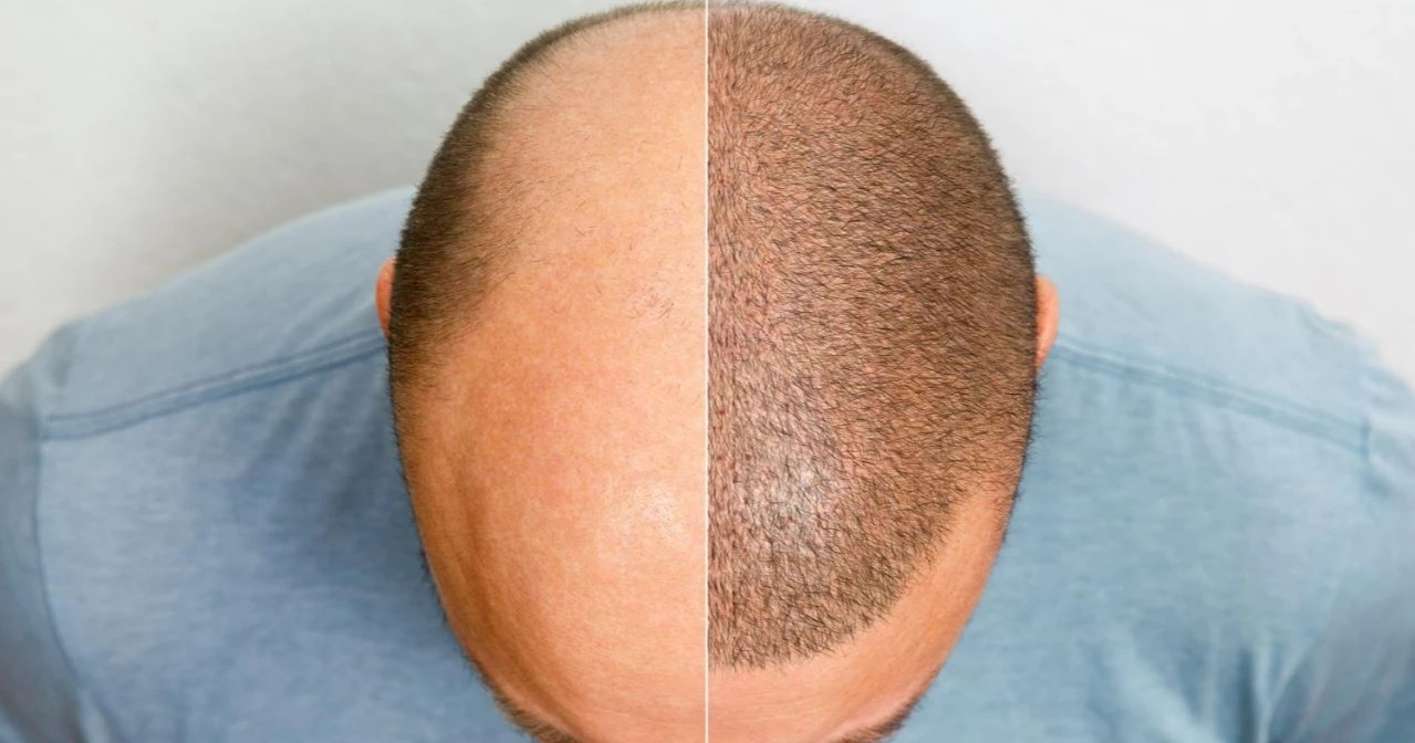 Which is the Best Country for Hair Transplant?