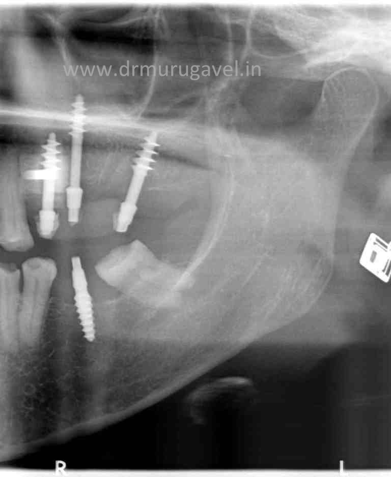 Basal implants for distall maxillary regionTuberosity implants in