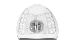 Removable Leaf Expander
