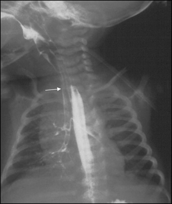 Having a video fluoroscopy CoughDoc Dr. Ian BalfourLyyn