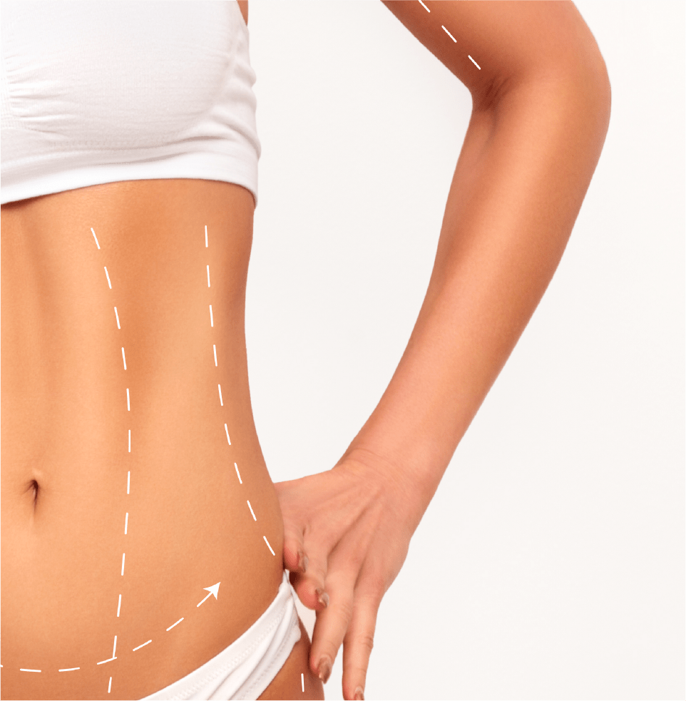 Dr. Couto MD Plastic Surgery Puerto Rico Abdominoplasty/ TummyTuck
