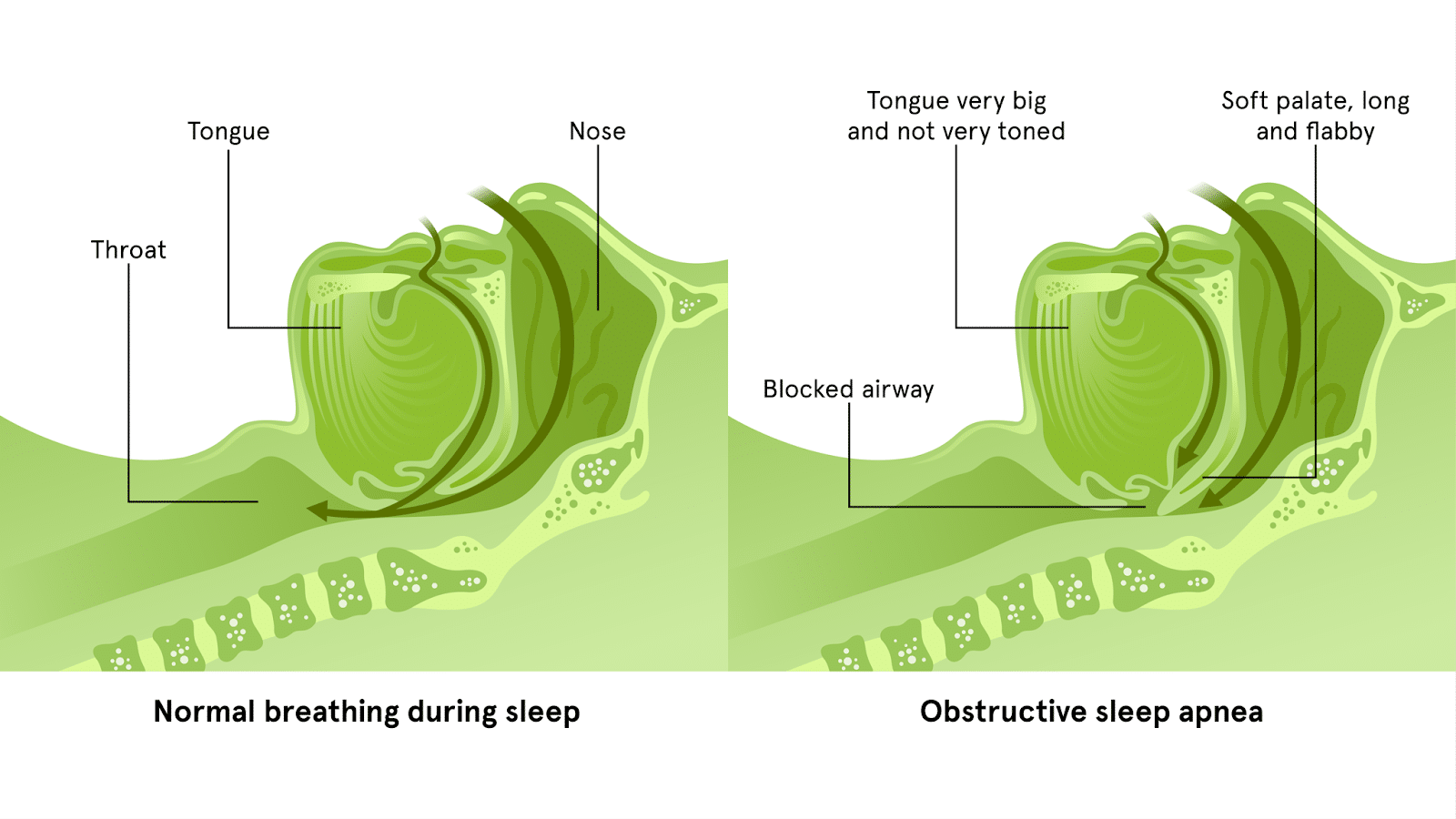 Does Sleep Apnea Cause Weight Gain? Exploring the Link