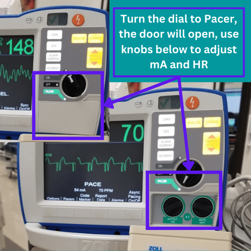 Transcutaneous Pacing (TCP) CPR Done Right CPR, ACLS, BLS Classes