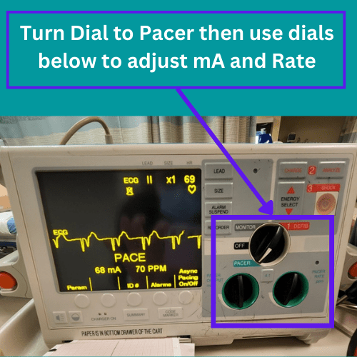 Transcutaneous Pacing (TCP) CPR Done Right CPR, ACLS, BLS Classes