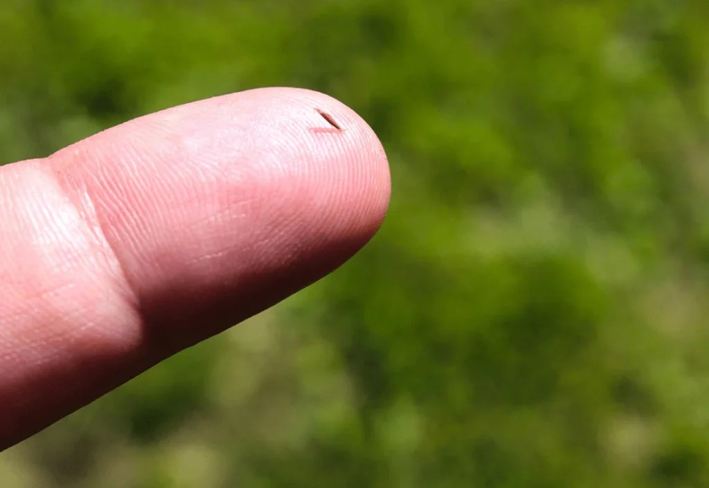 How To Get A Splinter Out CPR First Aid