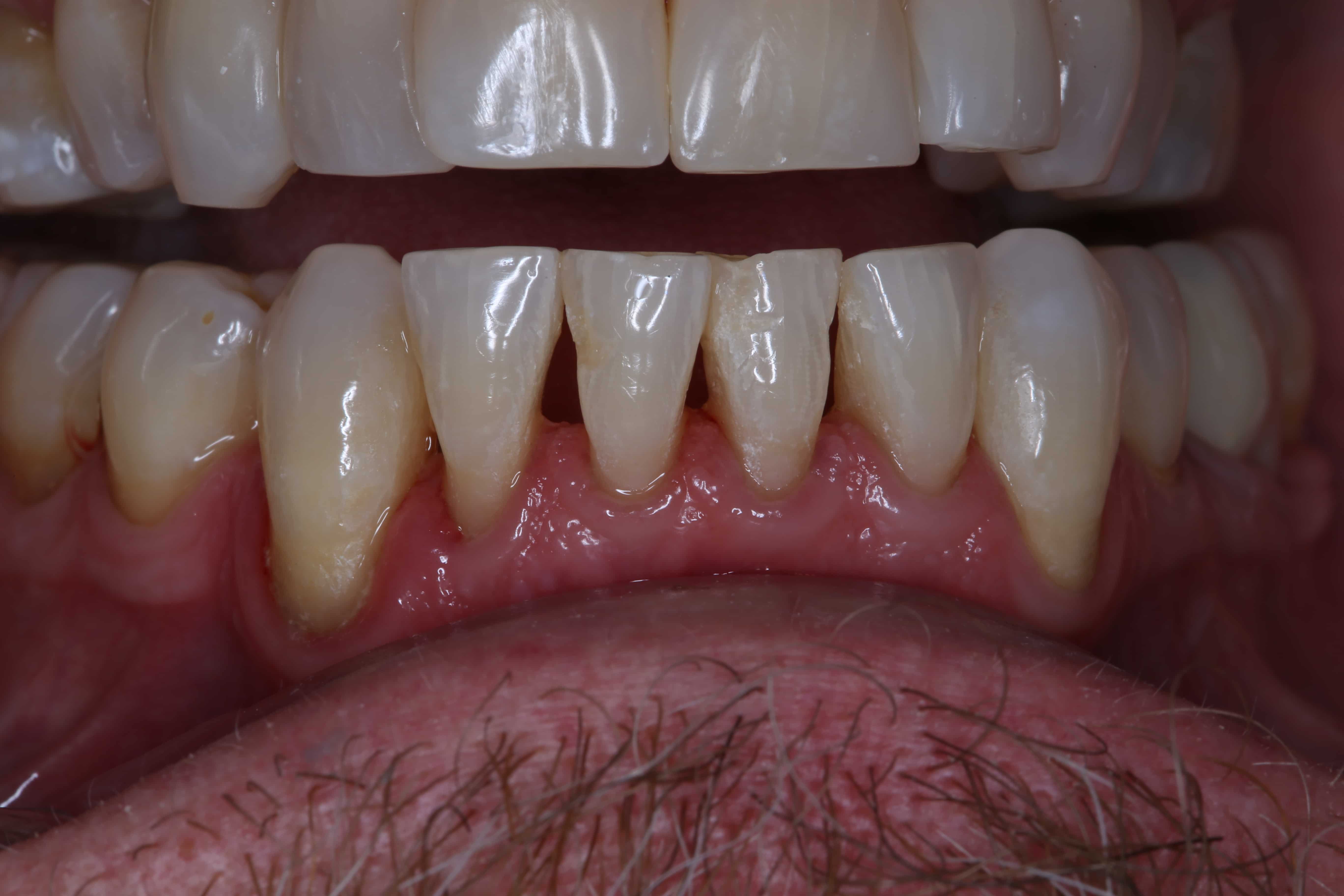 Black Lines On Back Teeth TeethWalls