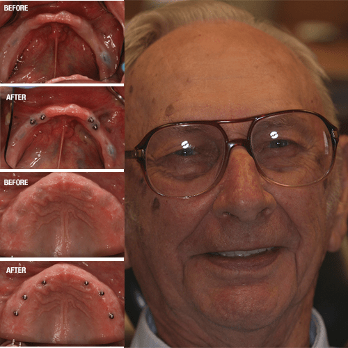 Mini Dental Implants Crane Family Dentistry • Crane, Missouri