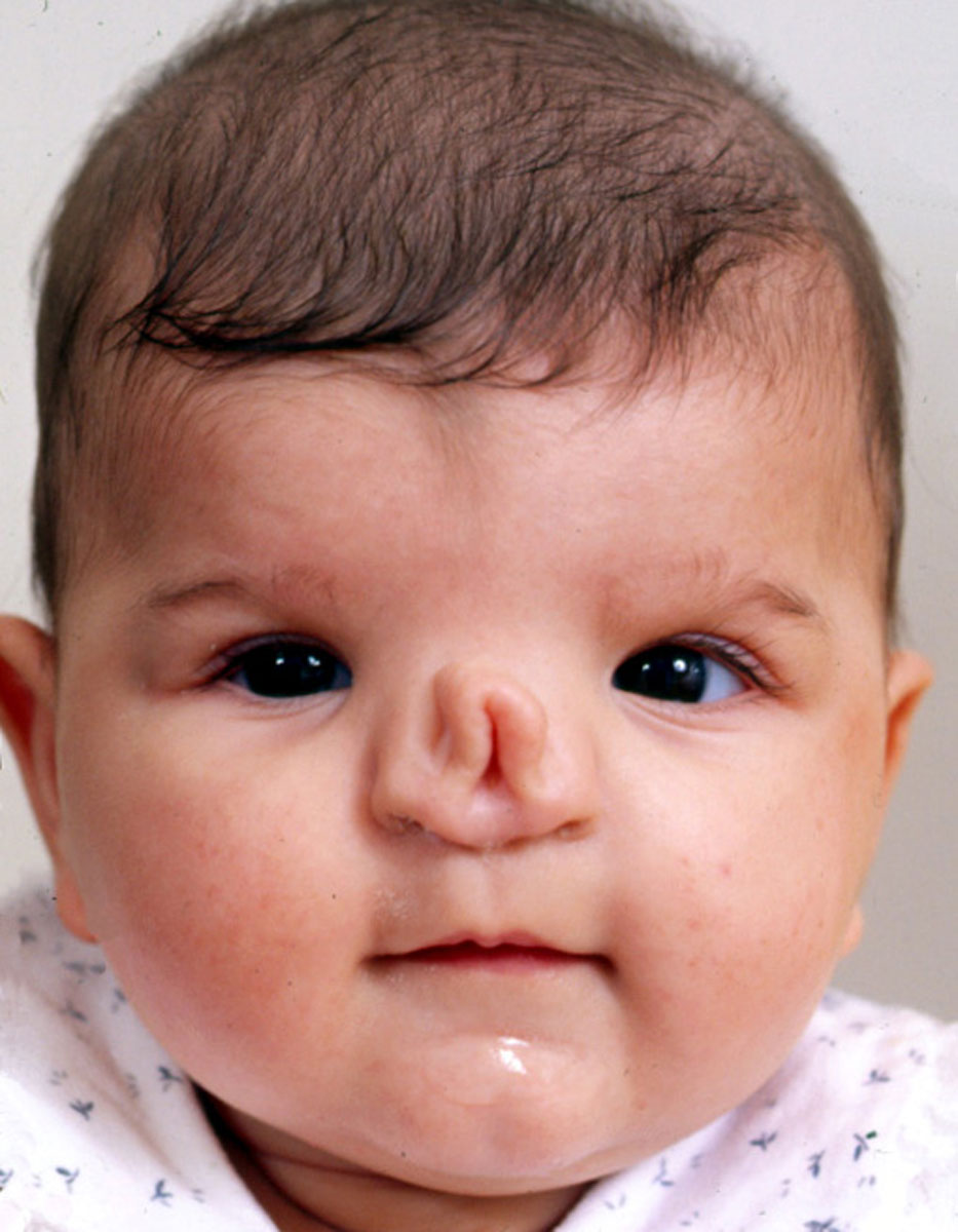 Craniofrontonasal Dysplasia Hellenic Craniofacial Center
