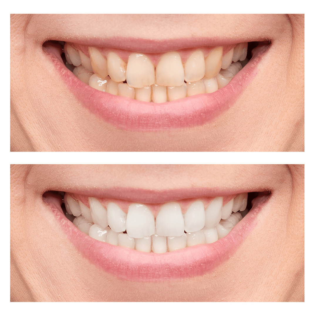 1 Hour Extreme ‘Naturawhite’ Laser Teeth Whitening (Protaras)