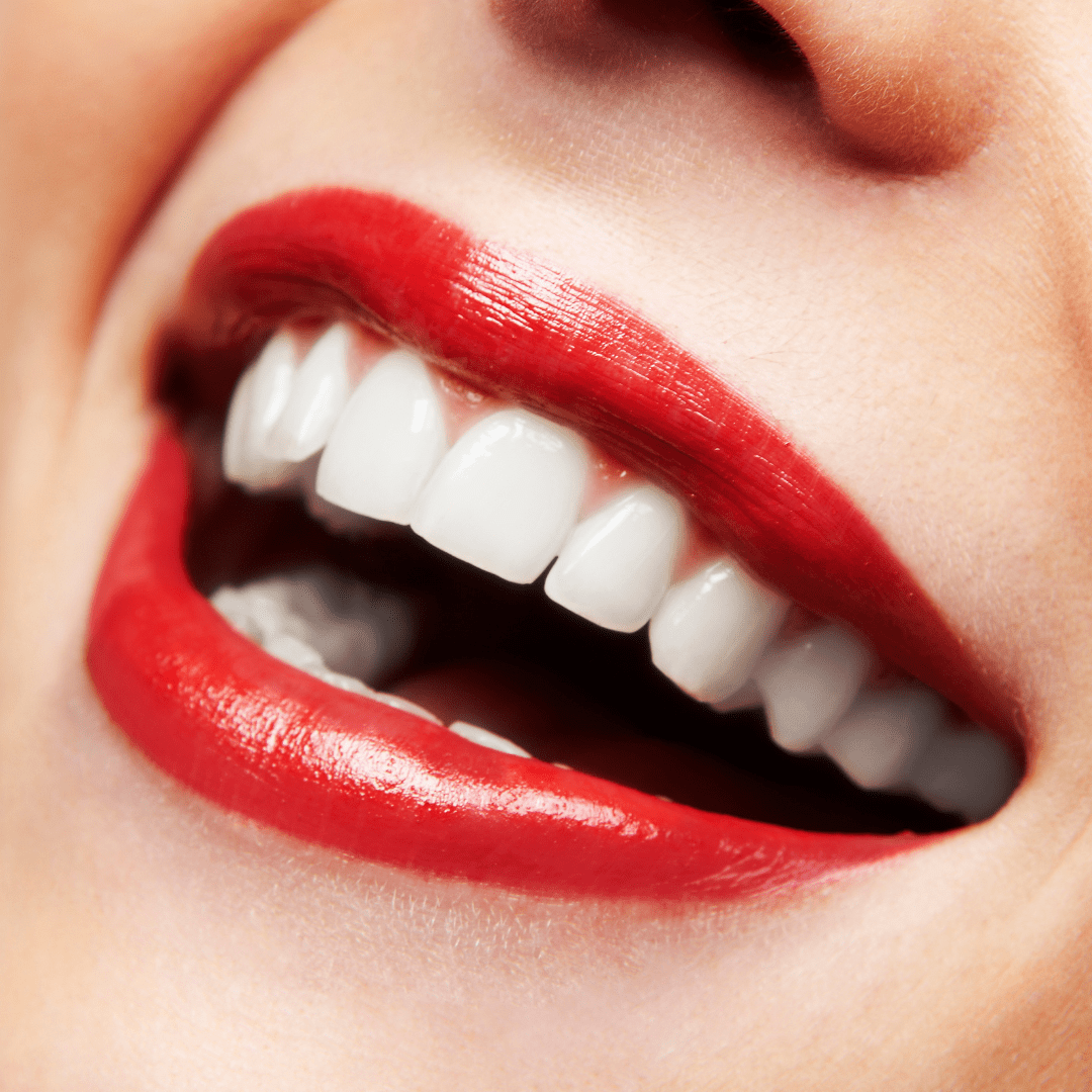 1 Hour Extreme ‘Naturawhite’ Laser Teeth Whitening (Protaras)