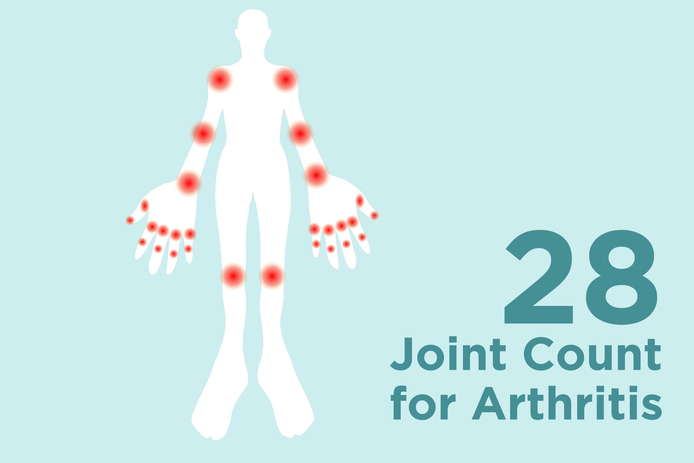 Joint Count Test for Arthritis What Is It?