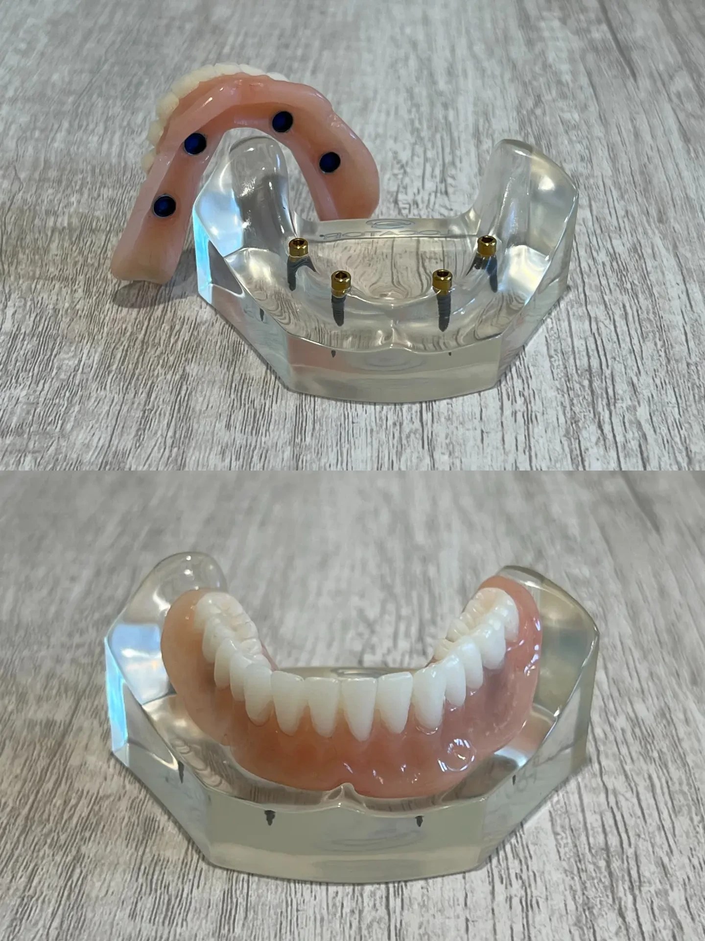 SnapIn Implant Dentures Villanova Dental Group & Implant Center