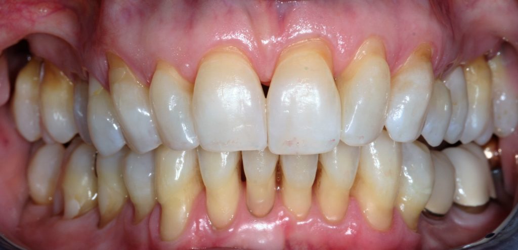 Gum Recession CreateSmiles by Dr. Brad Lockhart Tustin Dentist