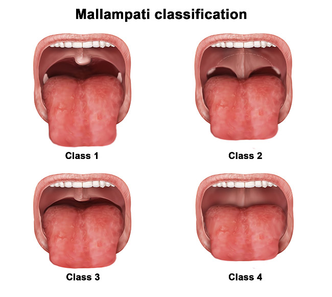 Sleep Apnea CreateSmiles By Dr Brad Lockhart Tustin Dentist
